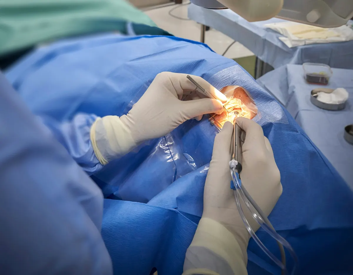 Chirurgie de la cataracte